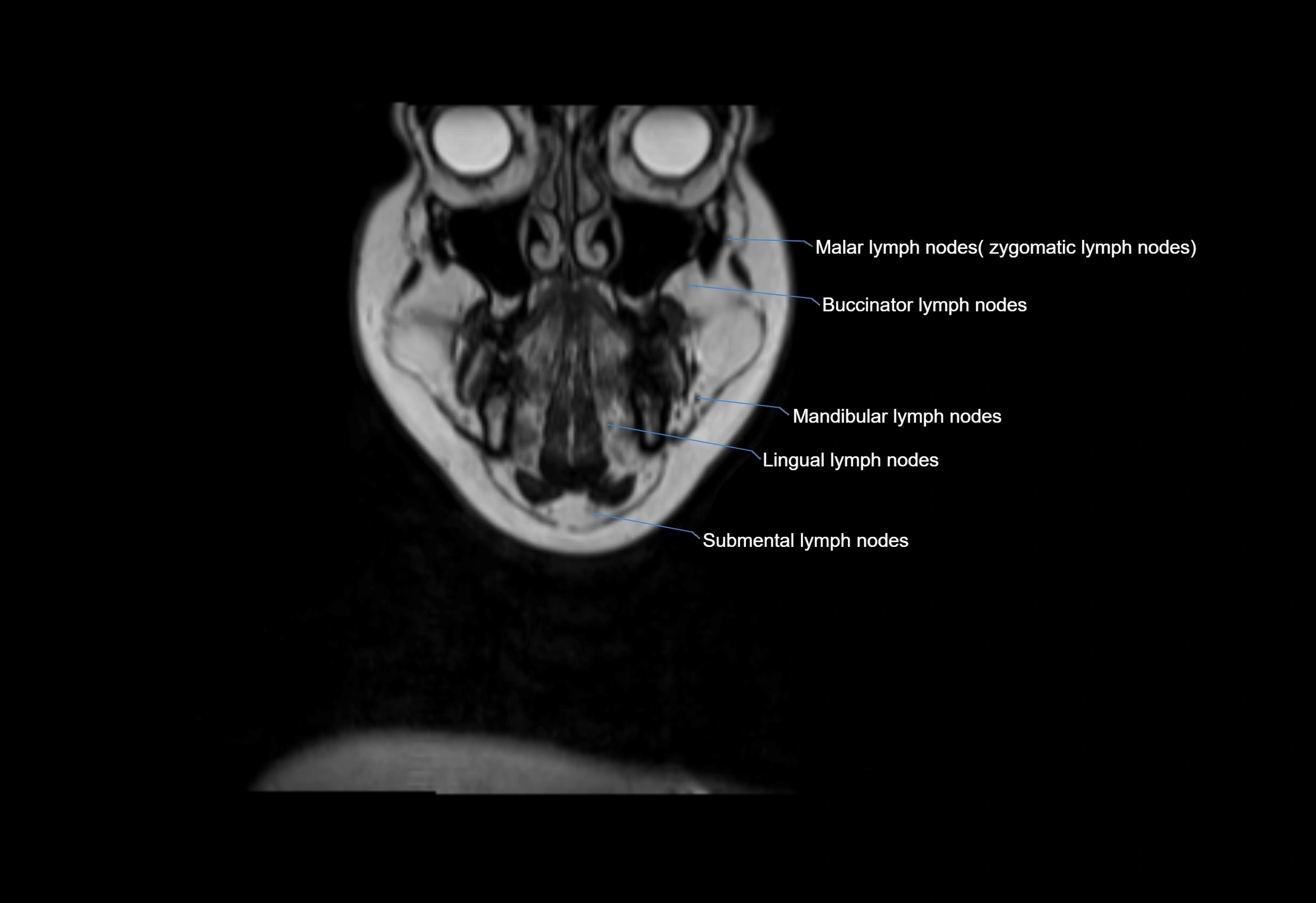Neck coronal lymph node cross sectional MRI anatomy 3T MRI  image-img-00001-00064.webp